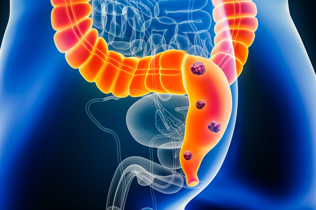 Colorectal cancer is one of the most common cancers worldwide—1 in 24 Americans are estimated to develop it at some point.