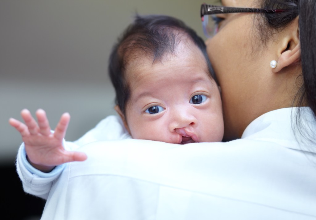 Portrait of a baby with a cleft palate looking over her mother's shoulder.